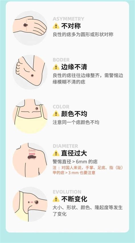 大痣|痣也可能会癌变！长在 3 个地方要注意